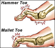 mallet toe icd 9 code